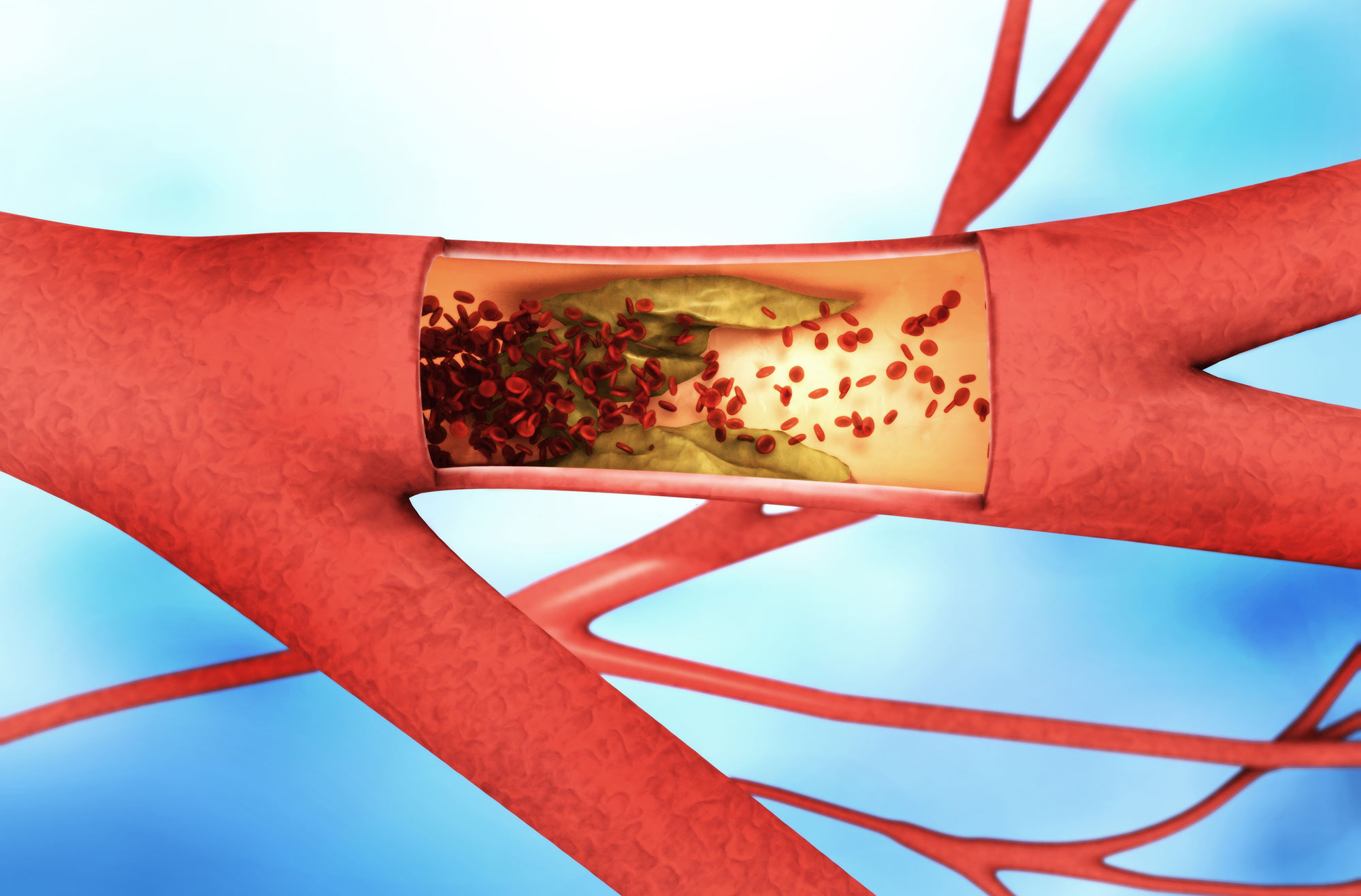 Peripheral Artery Disease PAD Penn Medicine